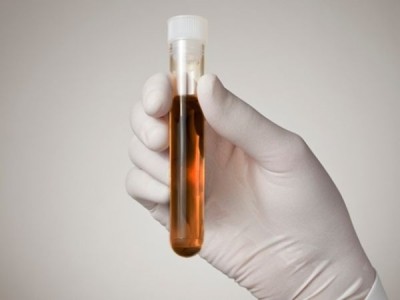 Caxias não registra casos da Síndrome de Haff