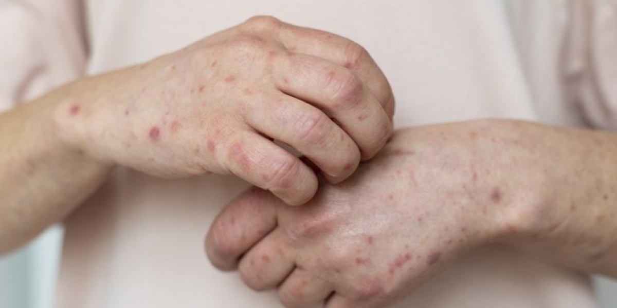 Maranhão chega a 22 casos de varíola dos macacos