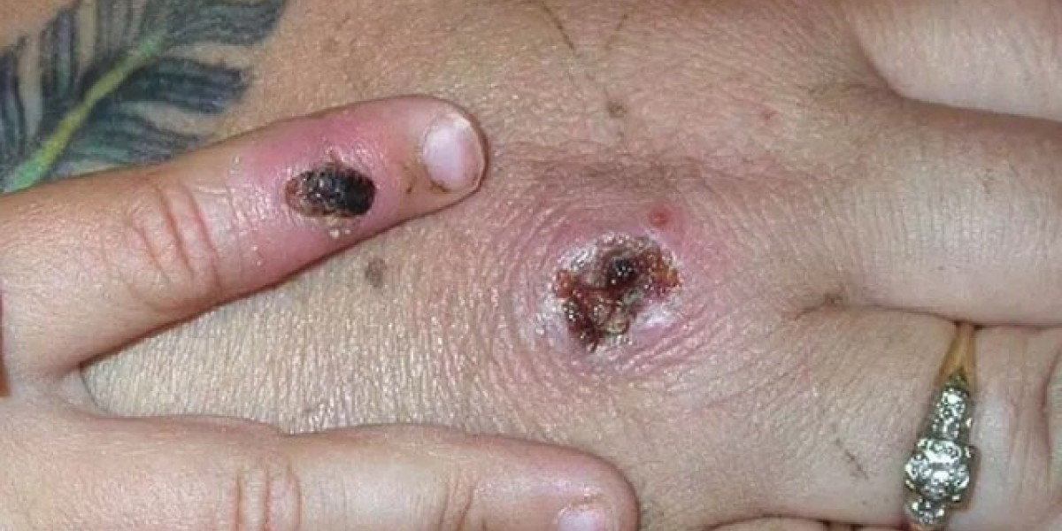 Imperatriz confirma 1ª morte por varíola dos macacos