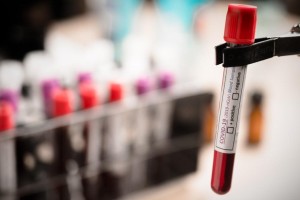 Exame de sangue capaz de detectar mais de 50 tipos de câncer chega ao Brasil