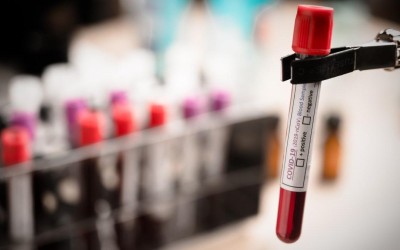 Exame de sangue capaz de detectar mais de 50 tipos de câncer chega ao Brasil