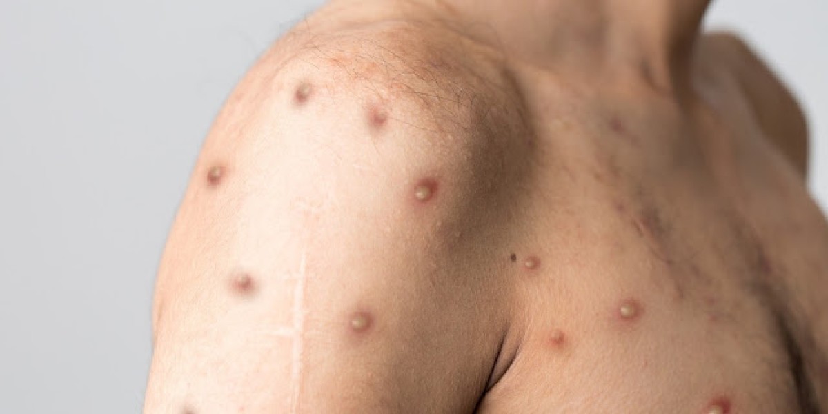 Confirmado primeiro caso de varíola do macaco no Maranhão