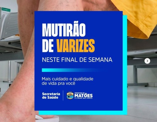 Prefeitura de Matões promove Mutirão de Varizes e amplia acesso da população a tratamentos de saúde