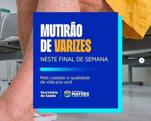 Prefeitura de Matões promove Mutirão de Varizes e amplia acesso da população a tratamentos de saúde