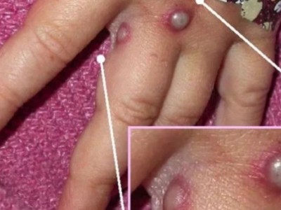 Timon tem dois casos suspeitos de varíola dos macacos