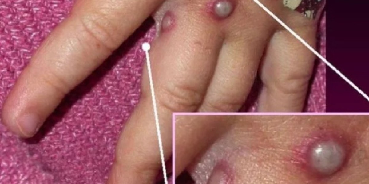 Timon tem dois casos suspeitos de varíola dos macacos