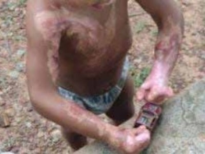 Maranhão tem todo ano mais de 12 mil pessoas internadas por queimaduras