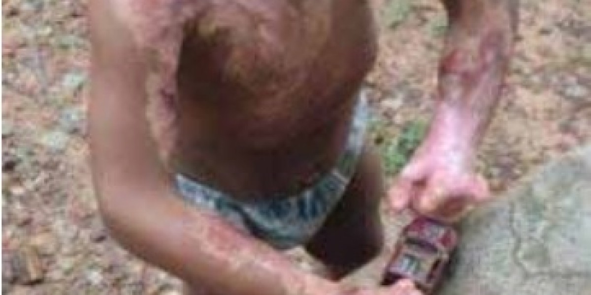 Maranhão tem todo ano mais de 12 mil pessoas internadas por queimaduras