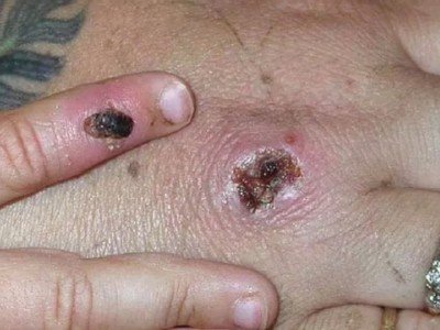 Imperatriz confirma 1ª morte por varíola dos macacos